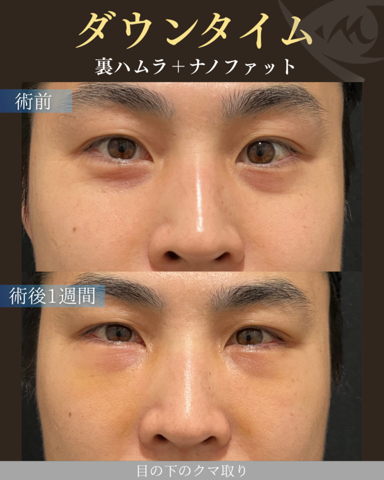 30代男性 裏ハムラ＋ナノファット ダウンタイム